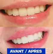 Stylo de Blanchiment des Dents – Sourire Éclatant en Quelques Minutes