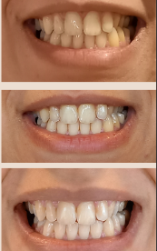 Kit de Blanchiment des Dents Professionnel/set de blanchiment des dents sans fil.